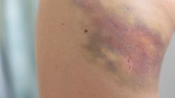 Obrażenia tkanek miękkich - przyczyny, objawy, leczenie