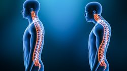 Kifoza - przyczyny, objawy, rozpoznanie, leczenie