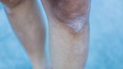 "Brudne kolana" to znak ostrzegawczy. Tak objawia się groźna choroba