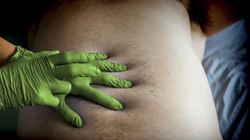 Zaczyna się od jelit. Ryzyko raka jelita grubego gwałtownie wzrasta