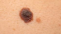 Usuwanie pieprzyków za pomocą tradycyjnych i innowacyjnych metod. Chirurgia, krioterapia, laseroterapia, elektrokoagulacja