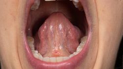 Jama ustna - budowa, choroby, grzybica jamy ustnej