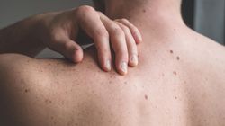 Zaczyna się od małej kropki. Nawet połowa zdiagnozowanych umiera