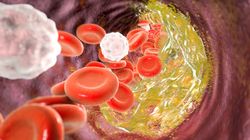 Cholesterol całkowity - normy, jak obniżyć cholesterol, wskazania do badania