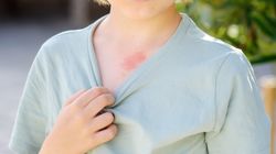 Malformacje naczyniowe - przyczyny, objawy i leczenie