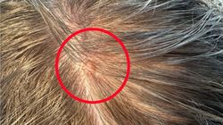 Ukrywają się we włosach, mogą być śmiertelnie groźne. Oto "zaćmienie słońca"