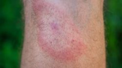 Najczęstsze pytania o boreliozę. Odpowiadają eksperci WP abcZdrowie