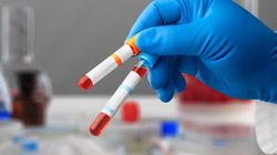 OB (odczyn Biernackiego) - charakterystyka, normy, interpretacja wyników