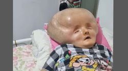 Jej głowa powiększyła się trzykrotnie. Od lat jest przykuta do łóżka