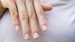 Zmiany na paznokciach, które mogą świadczyć o problemach ze zdrowiem. Nie ignoruj