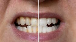 Chcesz wybielić zęby? Na te pasty uważaj