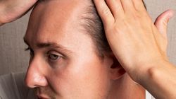 Wypadanie włosów. Dlaczego to spotyka coraz młodszych mężczyzn?