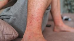 Objawy zakrzepicy mogą być widoczne. Jak obniżyć poziom d-dimerów?