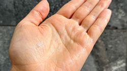 Dlaczego dłonie ciągle się pocą? Przyczyny i sposoby na nadpotliwość