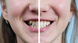 Czy warto robić bonding i ile kosztuje? Nie każdy będzie mógł sobie na to pozwolić