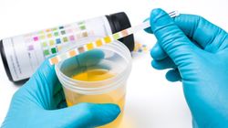 Czego szukamy w badaniu osadu moczu?