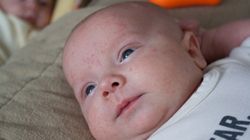 Trądzik niemowlęcy - charakterystyka, przyczyny, objawy i leczenie