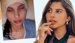 Eliza z „Hotelu Paradise” po fali hejtu zdecydowała się na operację odstających uszu. Pokazała efekt. „Jest tragicznie”