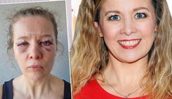 Anna Powierza wycięła nadmiar skóry z twarzy. Opowiedziała o zabiegu i pokazała odważne zdjęcia