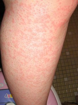burning rash on legs #10
