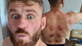 Co tam się wydarzyło?! Jan Błachowicz z potężnym bąblami