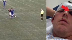 Tak wyglądało jego oko po zderzeniu. Tylko dla ludzi o mocnych nerwach