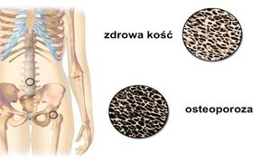 9 naturalnych sposobów na osteoporozę. Dzięki nim będziesz mieć zdrowe kości