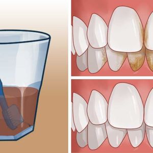 Te domowe metody pomogą Ci pozbyć się nieestetycznego kamienia nazębnego, a dodatkowo wybielą zęby