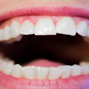 Czy usuwanie zębów mądrości naprawdę jest konieczne? Oto cała prawda na ten temat