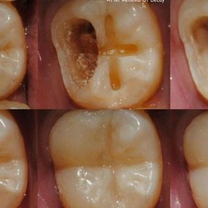 5 szybkich kroków do naprawienia ubytków w zębach. Obejdzie się bez dentysty!