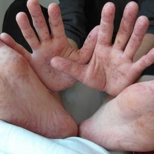 Czerwone plamy na dłoniach, stopach i twarzy mogą okazać się bardzo groźne dla Twojego zdrowia