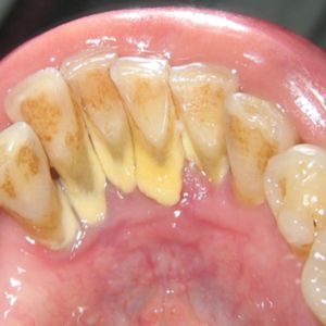 13 sposobów na pozbycie się płytki nazębnej i kamienia gromadzącego się na szkliwie zębów