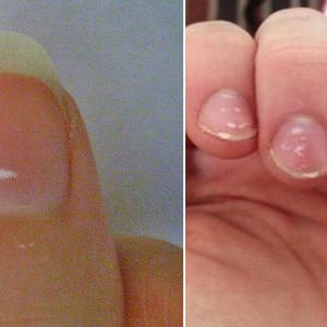 Białe plamy na paznokciach są poważnym sygnałem, którego lepiej nie ignorować