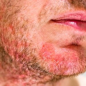 Łojotokowe zapalenie skóry – Jakie daje objawy i jak sobie z nim radzić?