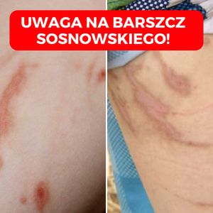 Barszcz Sosnowskiego zbiera żniwo wśród dzieci. Przypadki poparzenia II i III stopnia