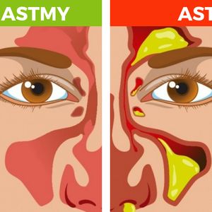 Twój organizm daje Ci wcześniej znać o nadchodzącej astmie. Zapalenie zatok jest jednym z nich