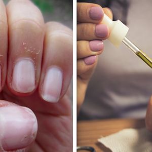 Suche skórki wokół paznokci – przyczyny i domowe sposoby na pozbycie się ich