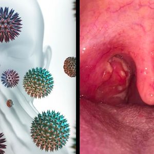 Zespół alergii jamy ustnej – co to jest, jak się objawia i czy można go wyleczyć?