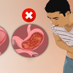 10 objawów zapalenia błony śluzowej żołądka. Cierpi na nie miliony Polaków