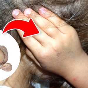 9 domowych sposobów, które pomogą Ci zwalczyć ból ucha. Antybiotyki wcale nie są konieczne