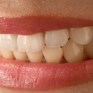 Wybielanie zębów domowymi sposobami. Podpowiadamy, których z nich lepiej unikać