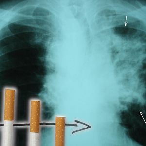 Rak płuc u osób, które nigdy nie paliły. Naukowcy coraz bliżej znalezienia przyczyn choroby