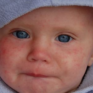 22 mln niemowląt nie otrzymało szczepionki. To „cisza przed burzą”