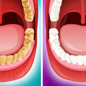 6 naturalnych sposobów na wybielenie zębów. Efektywnie usuniesz kamień nazębny