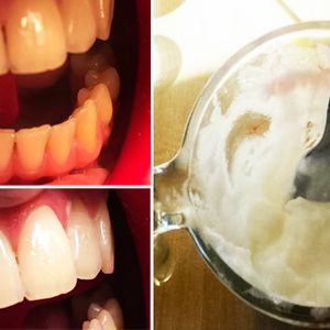 Domowy sposób na wybielanie zębów i usuwanie osadu nazębnego. Bez drogich wizyt u dentysty