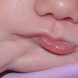 Niezwykle rzadka wada genetyczna sprawiła, że dziewczynka urodziła się z drugimi ustami