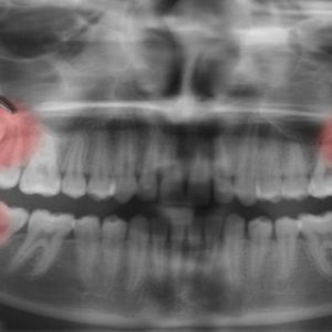 Naukowcy w końcu odkryli dlaczego zęby mądrości pojawiają się w tak późnym wieku