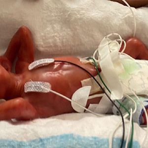 Najmłodszy wcześniak, który przeżył. Chłopiec urodził się w 21. tygodniu ciąży