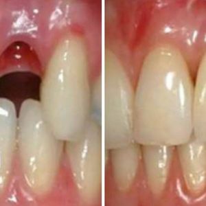 Naukowcy znaleźli sposób na „wyhodowanie” nowych zębów. Bez wywoływania skutków ubocznych