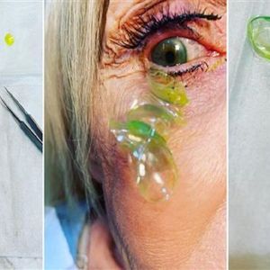 Kobieta zgłosiła się do optometrysty. W jej oku znajdowało się 23 „zaginione” soczewki